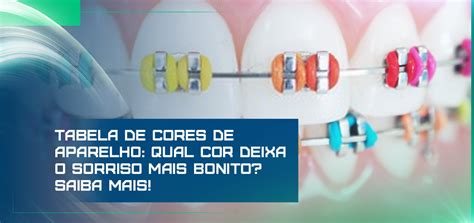 Tabela de cores de aparelho: qual cor deixa o sorriso .